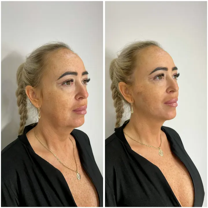 Klientka przed i po zabiegu nićmi liftingującymi, profil
